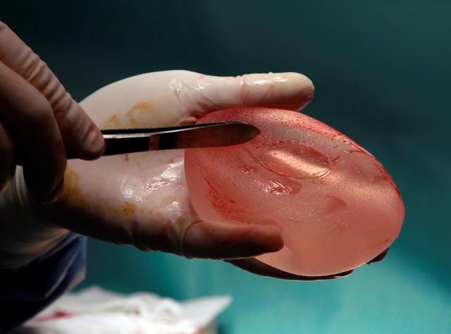 Women with defective French breast implants may claim damages only in France: EU court adviser