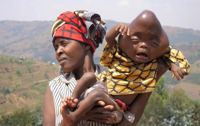 В Руанде женщина родила ребенка с головой в форме груши